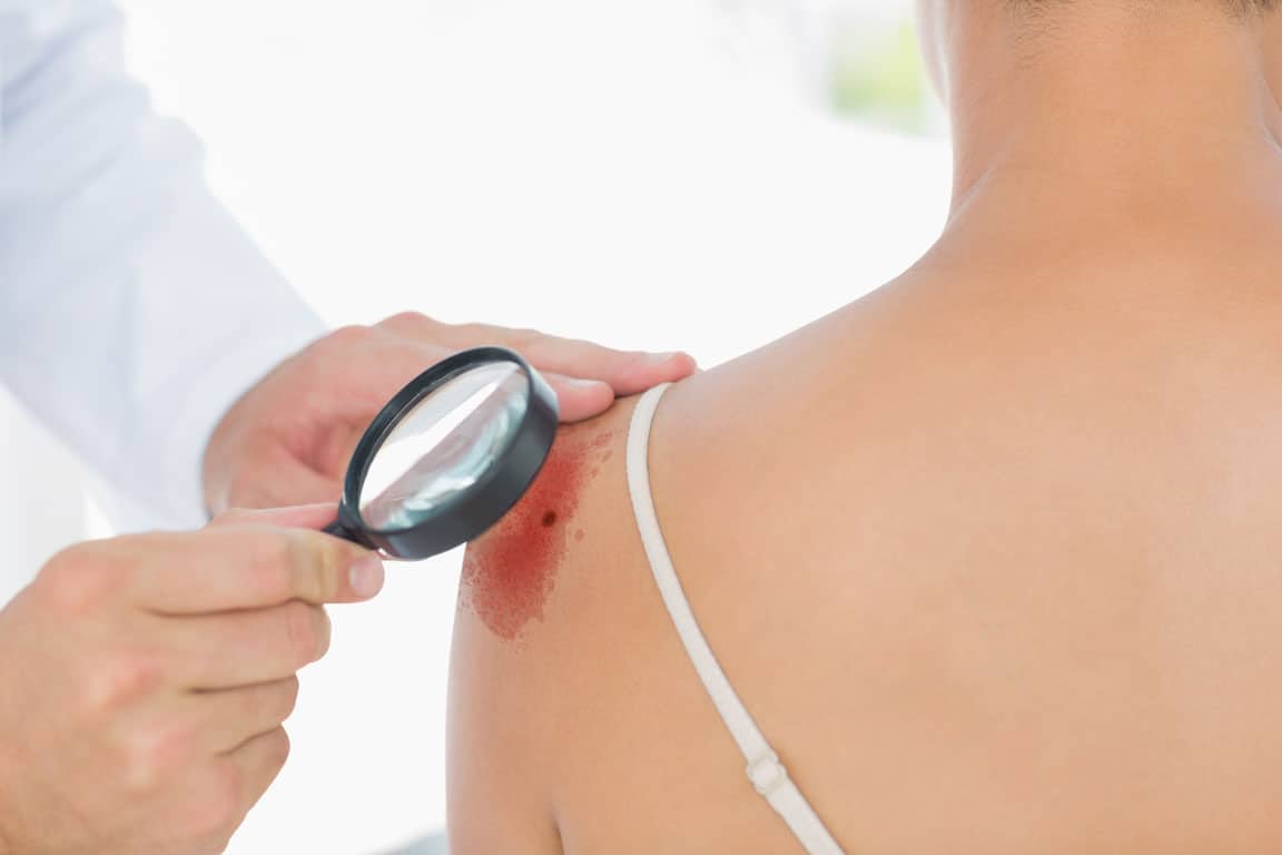 สะเก็ดเงิน-ต้องสะลอง-บาล์ม