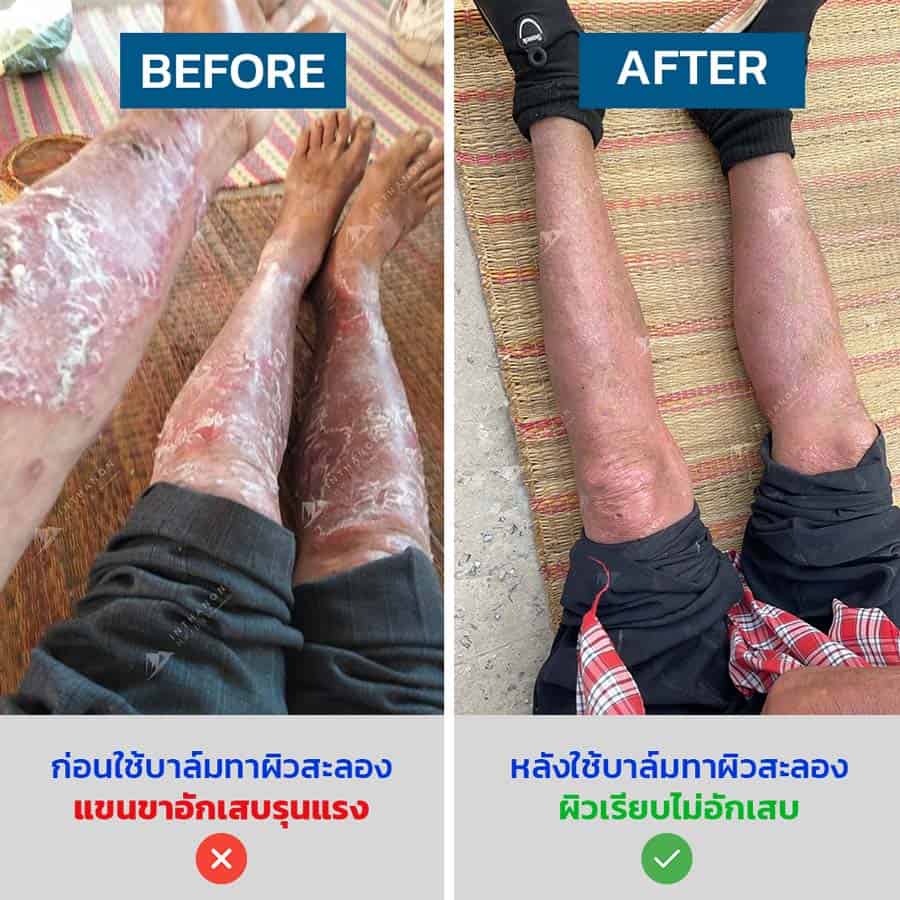 รีวิว-ครีม-บาล์มทาผิว-รักษา-สะเก็ดเงิน