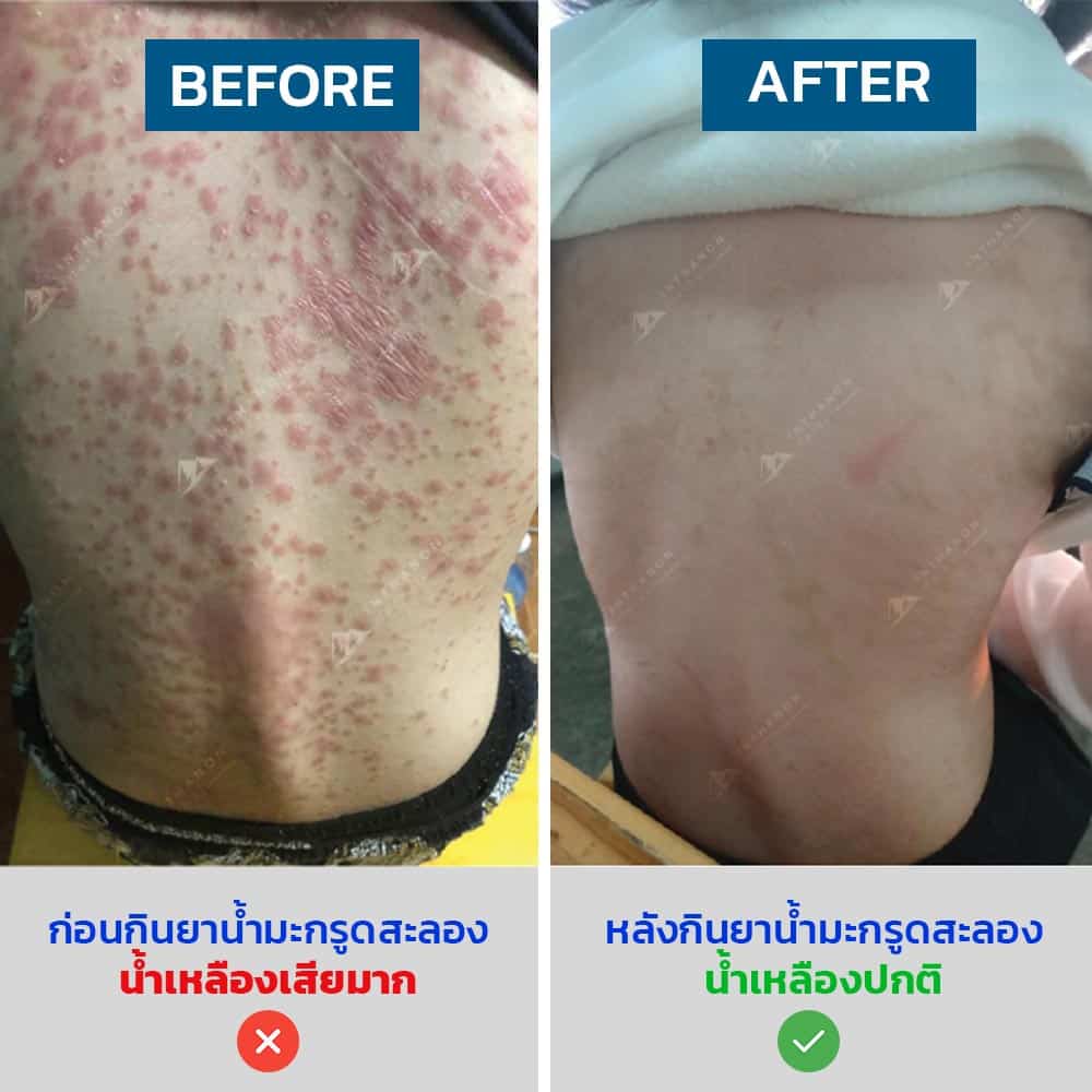 ปรับน้ำเหลือง-น้ำเหลืองเสีย-ยาน้ำมะกรูดสะลอง