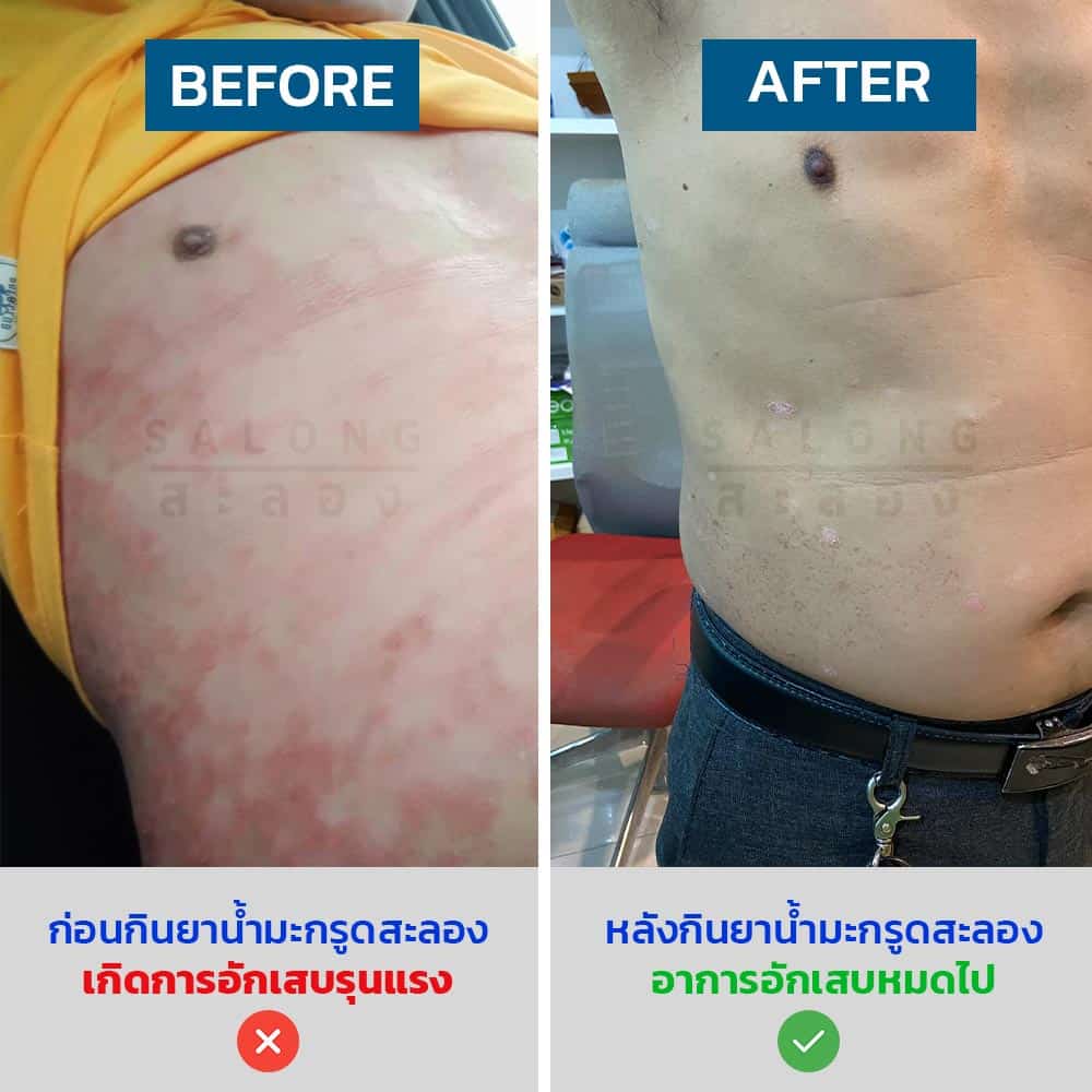 ลดการอักเสบ-ก่อนกิน-หลังกิน-ยาน้ำมะกรูดสะลอง