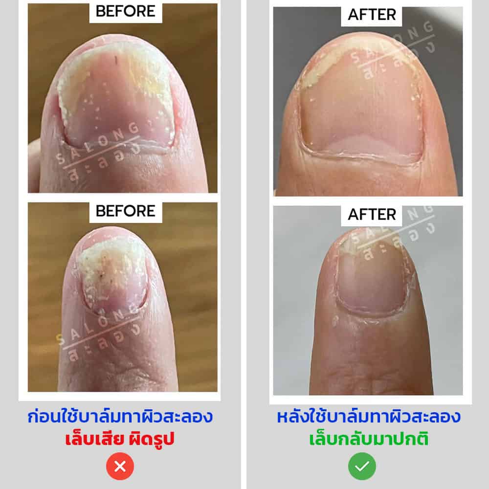 รีวิว-ครีม-บาล์มทาผิว-รักษา-สะเก็ดเงิน