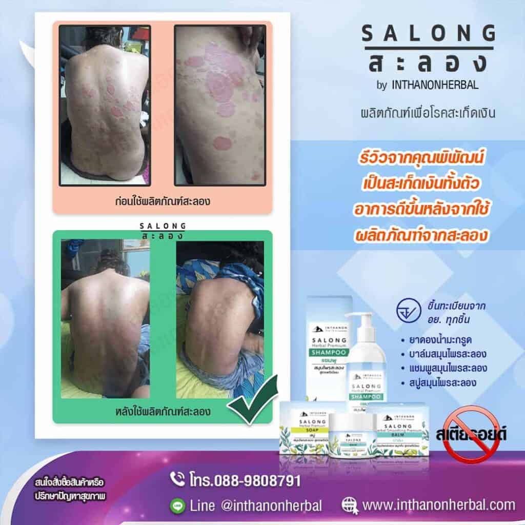 รีวิว-โรคสะเก็ดเงิน-01