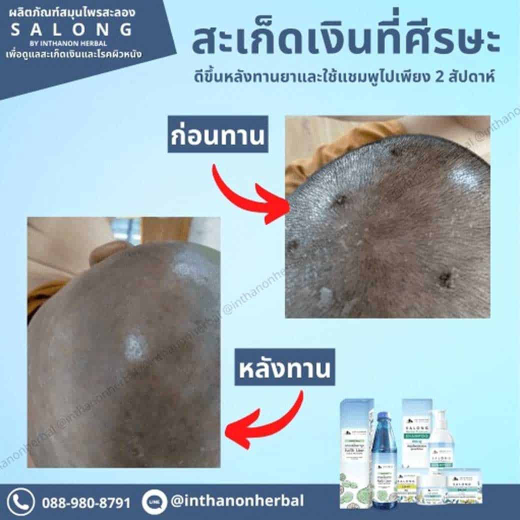 ตุ่ม-ที่หัว-คัน-แดง